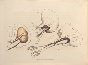 view Plate XX, Surgical removal of a bladder stone using a bistoury and forceps.