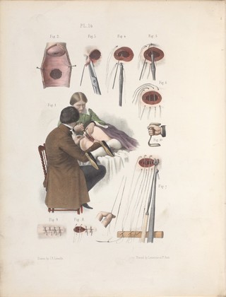 The surgery, surgical pathology and surgical anatomy of the female pelvic organs : in a series of colored plates taken from nature with commentaries, notes and cases / by Henry Savage, M.D.