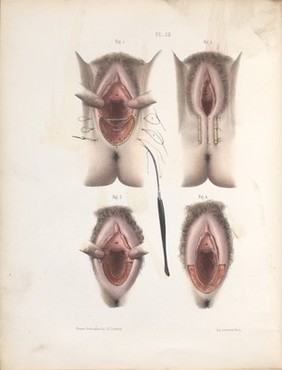 The surgery, surgical pathology and surgical anatomy of the female pelvic organs : in a series of colored plates taken from nature with commentaries, notes and cases / by Henry Savage, M.D.