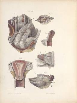 The surgery, surgical pathology and surgical anatomy of the female pelvic organs : in a series of colored plates taken from nature with commentaries, notes and cases / by Henry Savage, M.D.
