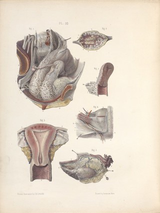 The surgery, surgical pathology and surgical anatomy of the female pelvic organs : in a series of colored plates taken from nature with commentaries, notes and cases / by Henry Savage, M.D.