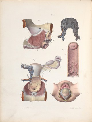 The surgery, surgical pathology and surgical anatomy of the female pelvic organs : in a series of colored plates taken from nature with commentaries, notes and cases / by Henry Savage, M.D.