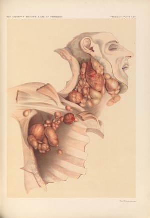 view Plate LXV, Post-mortem view of enlarged lymphoma glands.