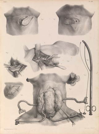 Traité complet de l'anatomie de l'homme comprenant la médecine opératoire ... : avec planches lithographiées ... / par N.H. Jacob.