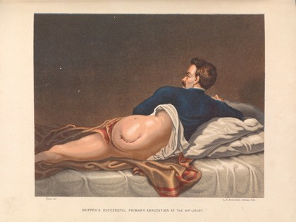 A report on amputations at the hip-joint in military surgery / by George A. Otis.