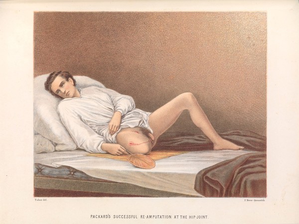 A report on amputations at the hip-joint in military surgery / by George A. Otis.