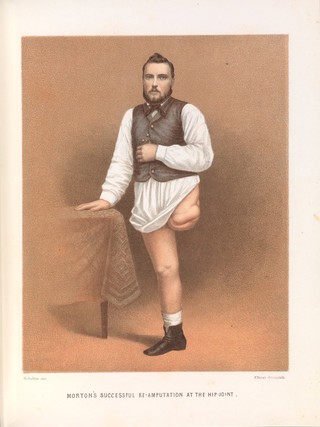 A report on amputations at the hip-joint in military surgery / by George A. Otis.