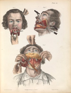 view Plate XXVI. Resection of the lower jaw.