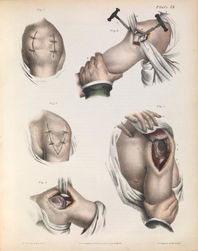 A treatise on operative surgery comprising a description of the various processes of the art, including all the new operations; exhibiting the state of surgical science in its present advanced condition; with eighty plates, containing four hundred and eighty-six separate illustrations. Second edition, revised and enlarged / by Joseph Pancoast.