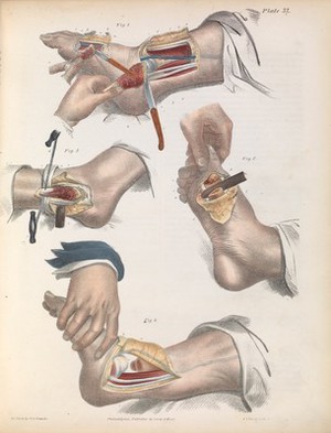 view Plate XXXII. Resection of the bones of the ankle and foot.