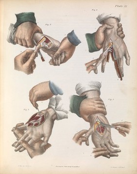 A treatise on operative surgery comprising a description of the various processes of the art, including all the new operations; exhibiting the state of surgical science in its present advanced condition; with eighty plates, containing four hundred and eighty-six separate illustrations. Second edition, revised and enlarged / by Joseph Pancoast.