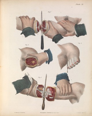 A treatise on operative surgery comprising a description of the various processes of the art, including all the new operations; exhibiting the state of surgical science in its present advanced condition; with eighty plates, containing four hundred and eighty-six separate illustrations. Second edition, revised and enlarged / by Joseph Pancoast.