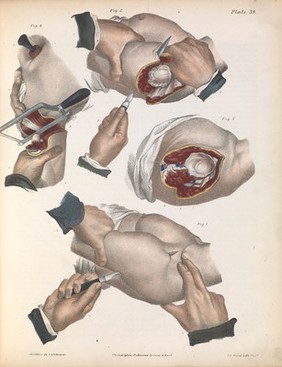 A treatise on operative surgery comprising a description of the various processes of the art, including all the new operations; exhibiting the state of surgical science in its present advanced condition; with eighty plates, containing four hundred and eighty-six separate illustrations. Second edition, revised and enlarged / by Joseph Pancoast.