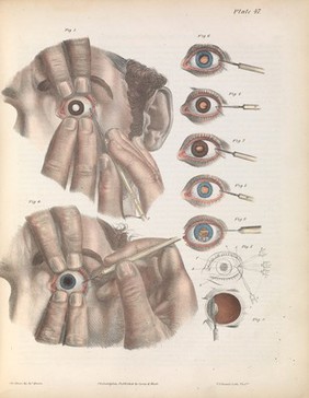 A treatise on operative surgery comprising a description of the various processes of the art, including all the new operations; exhibiting the state of surgical science in its present advanced condition; with eighty plates, containing four hundred and eighty-six separate illustrations. Second edition, revised and enlarged / by Joseph Pancoast.