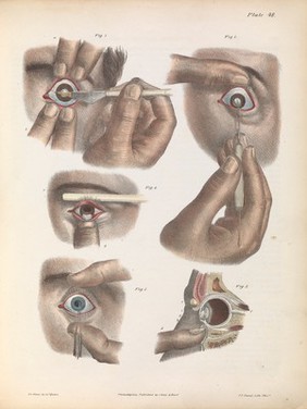 A treatise on operative surgery comprising a description of the various processes of the art, including all the new operations; exhibiting the state of surgical science in its present advanced condition; with eighty plates, containing four hundred and eighty-six separate illustrations. Second edition, revised and enlarged / by Joseph Pancoast.