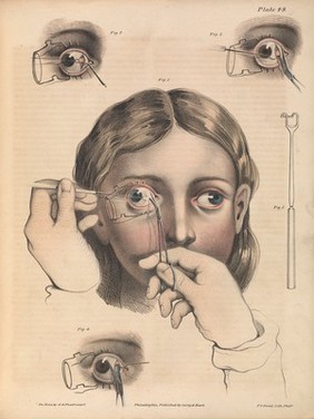 A treatise on operative surgery comprising a description of the various processes of the art, including all the new operations; exhibiting the state of surgical science in its present advanced condition; with eighty plates, containing four hundred and eighty-six separate illustrations. Second edition, revised and enlarged / by Joseph Pancoast.