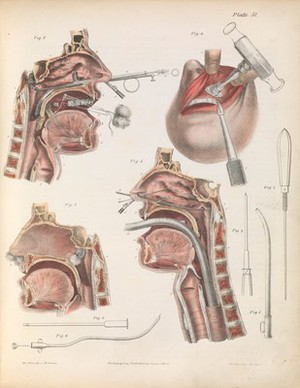 view Plate LI. Surgery on the cavities of the face and throat.