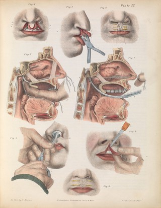 Plate LII. Surgical technique for nasal polypi and hare-lip.