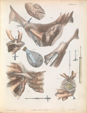 view Plate LVIII. Surgical technique for the repair of a hernia.