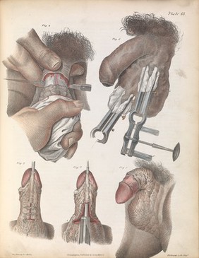 Plate LXIII. Surgical techniques performed on male genitalia.