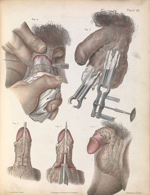 view Plate LXIII. Surgical techniques performed on male genitalia.