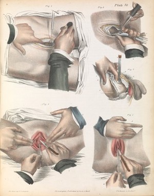 view Plate LXX. Surgical technique for lithotomy.