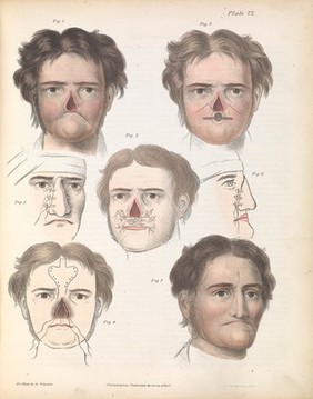 Plate LXXII. Plastic surgery on the lip and nose.