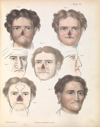 Plate LXXII. Plastic surgery on the lip and nose.
