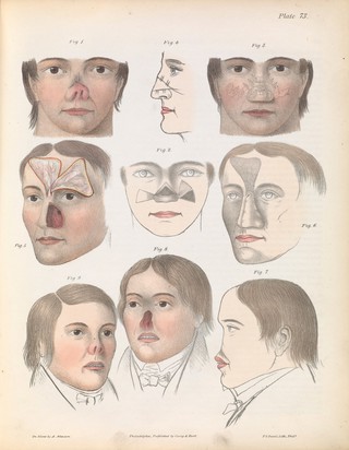 Plate LXXIII. Surgical technique for rhinoplasty.
