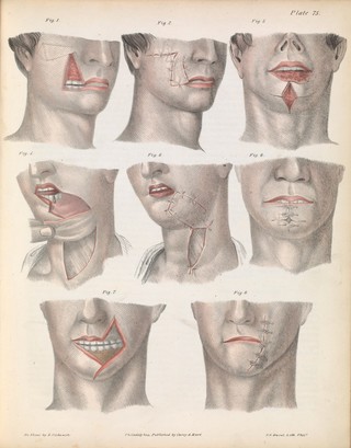 A treatise on operative surgery comprising a description of the various processes of the art, including all the new operations; exhibiting the state of surgical science in its present advanced condition; with eighty plates, containing four hundred and eighty-six separate illustrations. Second edition, revised and enlarged / by Joseph Pancoast.