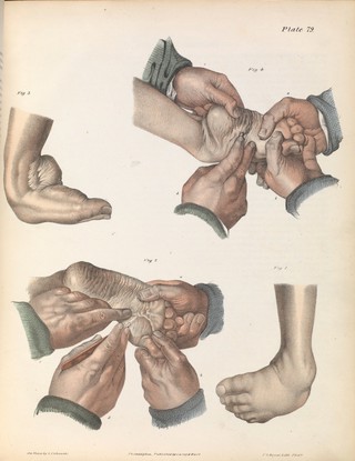 A treatise on operative surgery comprising a description of the various processes of the art, including all the new operations; exhibiting the state of surgical science in its present advanced condition; with eighty plates, containing four hundred and eighty-six separate illustrations. Second edition, revised and enlarged / by Joseph Pancoast.