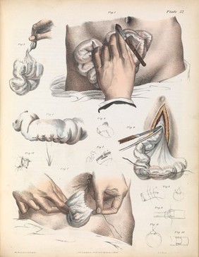 Plate LVII. Suturing techniques practised on the small intestines.