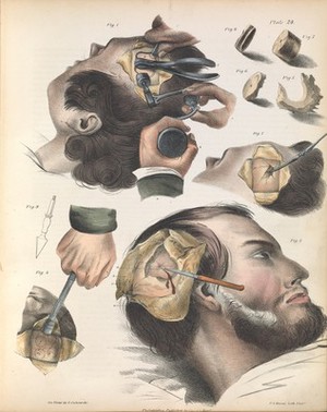 view Plate XXIV. Trepanning or trephining of the cranium.