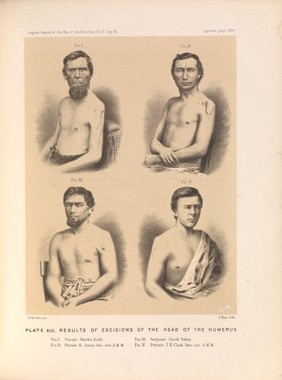 Plate XIII. Results of excisions of the head of the humerus. American Civil War (1861-65).