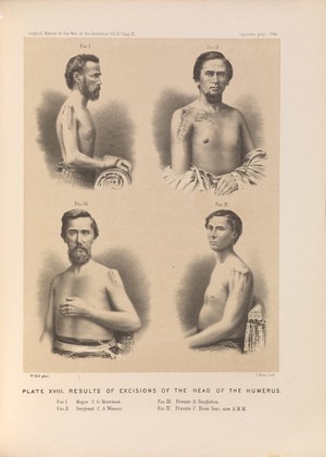 view Plate XVIII. Results of excisions of the head of the humerus. American Civil War (1861-65).