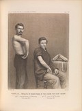 view Plate LIV. Results of resections at the elbow for shot injury. American Civil War (1861-65).