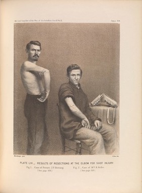 Plate LIV. Results of resections at the elbow for shot injury. American Civil War (1861-65).