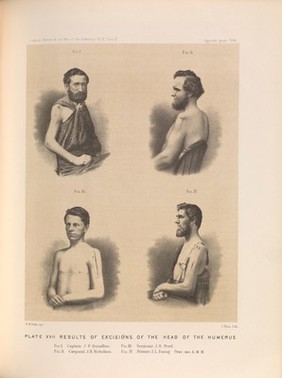 Plate XVII. Results of excisions of the head of the humerus. American Civil War (1861-65).