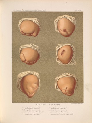 The medical and surgical history of the war of the rebellion, (1861-65) / Prepared, in accordance with the acts of Congress, under the direction of Surgeon General, Joseph K. Barnes, United States Army.