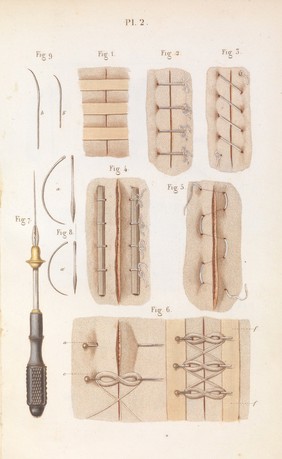 Précis iconographique de médecine opératoire et d'anatomie chirurgicale / [Claude Bernard].