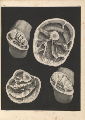 Traité complet de l'anatomie de l'homme comprenant la médecine opératoire ... : avec planches lithographiées ... / par N.H. Jacob.