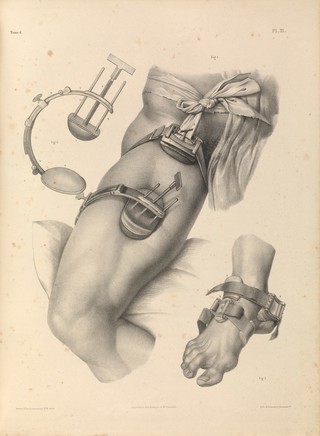 Traité complet de l'anatomie de l'homme comprenant la médecine opératoire ... : avec planches lithographiées ... / par N.H. Jacob.