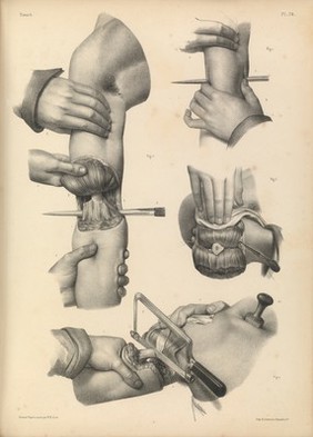 Traité complet de l'anatomie de l'homme comprenant la médecine opératoire ... : avec planches lithographiées ... / par N.H. Jacob.