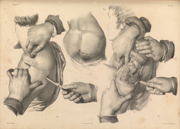 Traité complet de l'anatomie de l'homme comprenant la médecine opératoire ... : avec planches lithographiées ... / par N.H. Jacob.