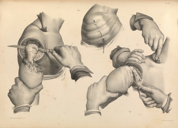 Traité complet de l'anatomie de l'homme comprenant la médecine opératoire ... : avec planches lithographiées ... / par N.H. Jacob.