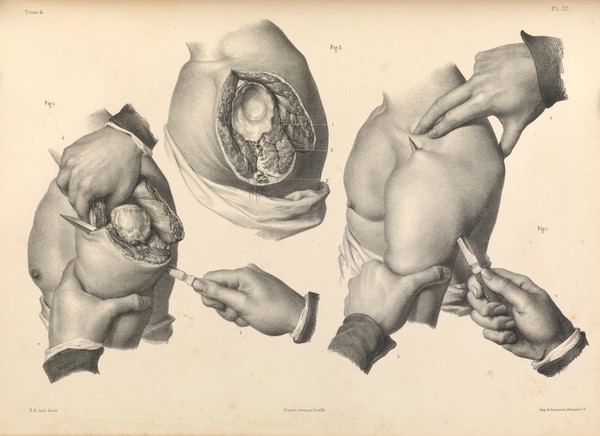 Traité complet de l'anatomie de l'homme comprenant la médecine opératoire ... : avec planches lithographiées ... / par N.H. Jacob.