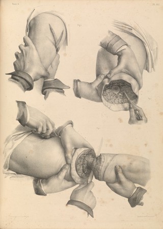 Traité complet de l'anatomie de l'homme comprenant la médecine opératoire ... : avec planches lithographiées ... / par N.H. Jacob.