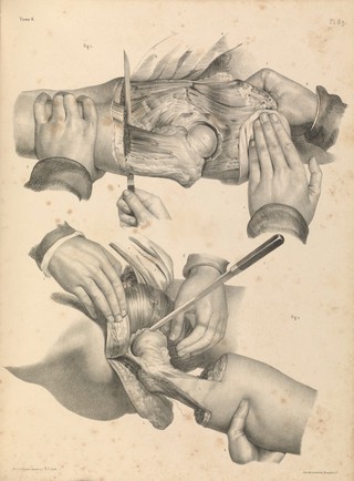 Traité complet de l'anatomie de l'homme comprenant la médecine opératoire ... : avec planches lithographiées ... / par N.H. Jacob.