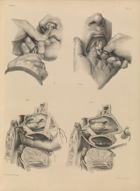 Traité complet de l'anatomie de l'homme comprenant la médecine opératoire ... : avec planches lithographiées ... / par N.H. Jacob.