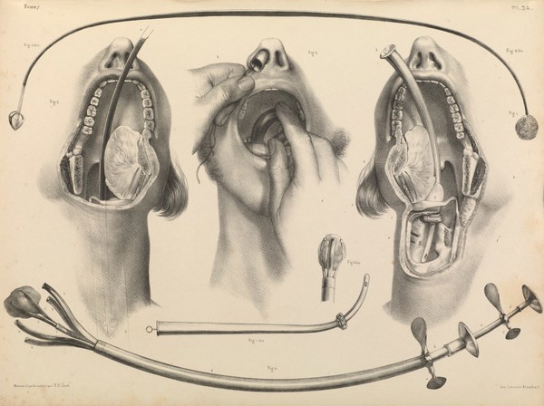 Traité complet de l'anatomie de l'homme comprenant la médecine opératoire ... : avec planches lithographiées ... / par N.H. Jacob.